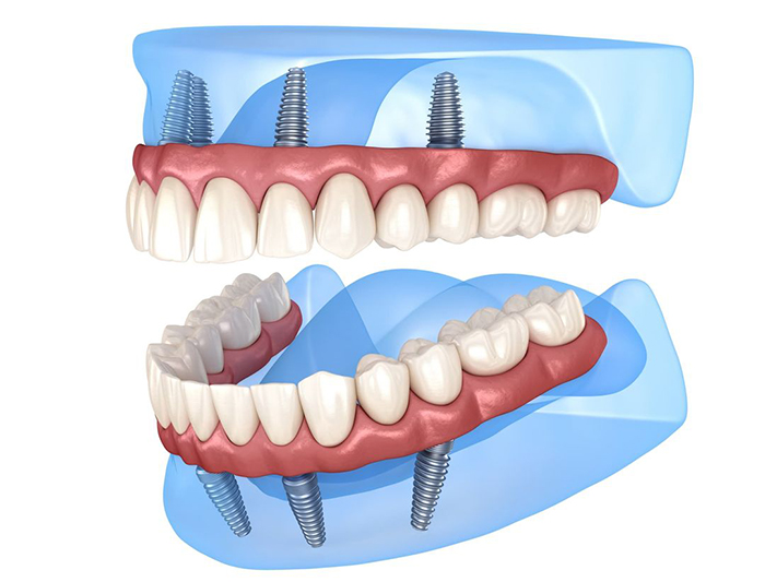 All-On-4 dental implants illustration for Newnan implant dentistry and tooth restoration