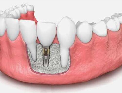 What is Bone Grafting for Dental Implant Treatment in Newnan, GA?