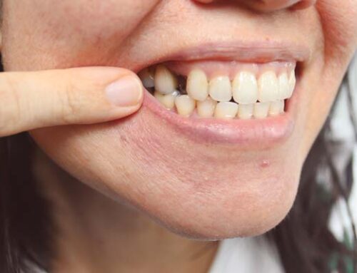 What Happens If You Don’t Replace Missing Teeth?